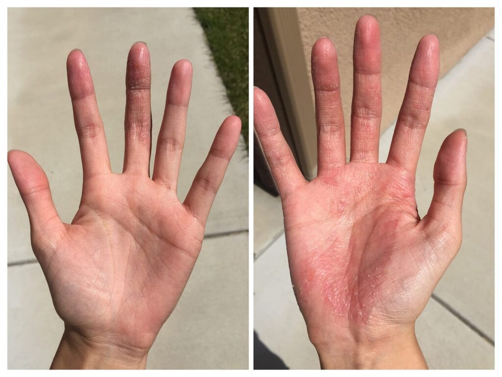 Symptoms-Of-Eczema-skin-treatment