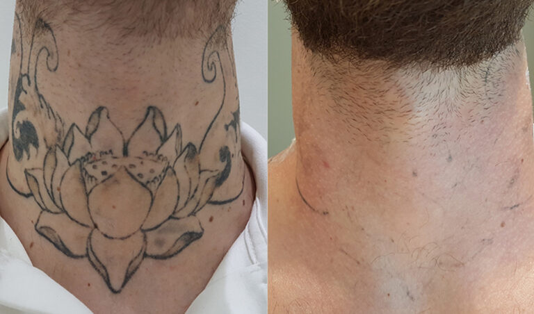 neck-tattoo-removel-after-and-before