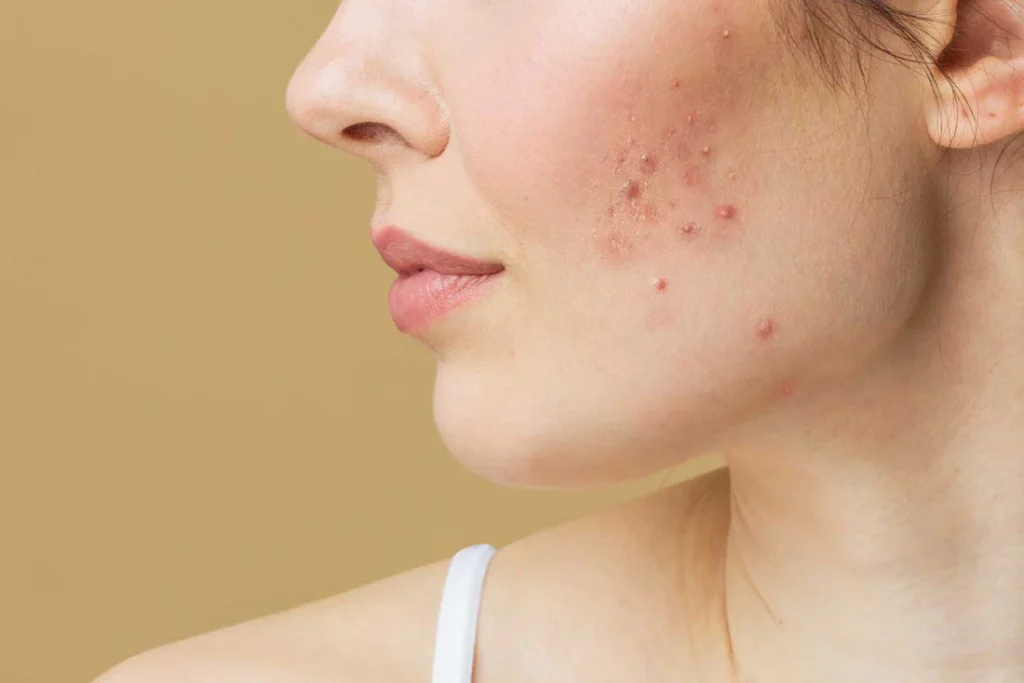 Acne-Scar-Treatment​