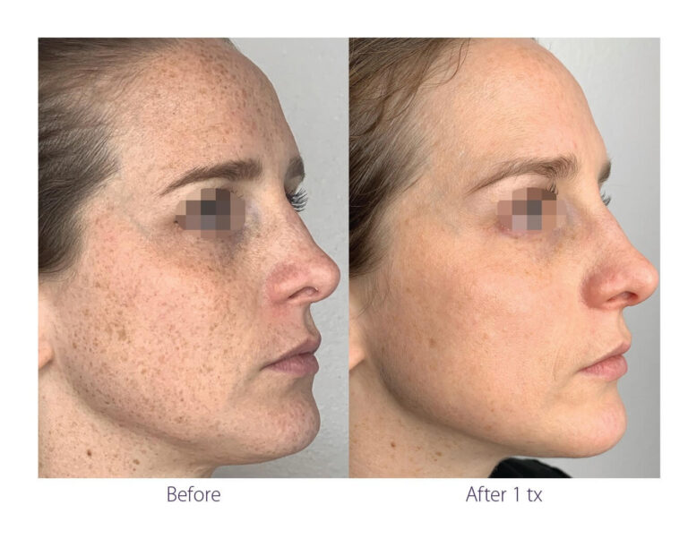Laser-For-Pigmented-Lesions-before-and-after