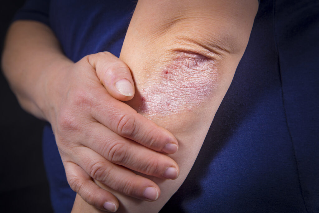 Psoriasis​-skin-treatment
