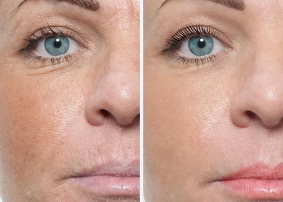 PRP-Facial-Before-and-After