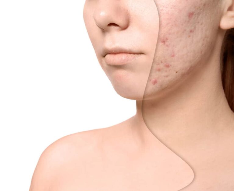 Laser-For-Acne-&-Lesions​Acne-Scar-Before-and-After