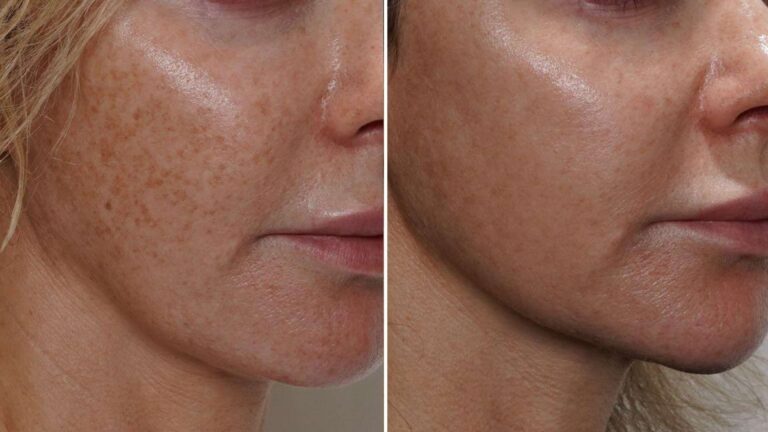 Laser-For-Pigmented-Lesions-before-and-after