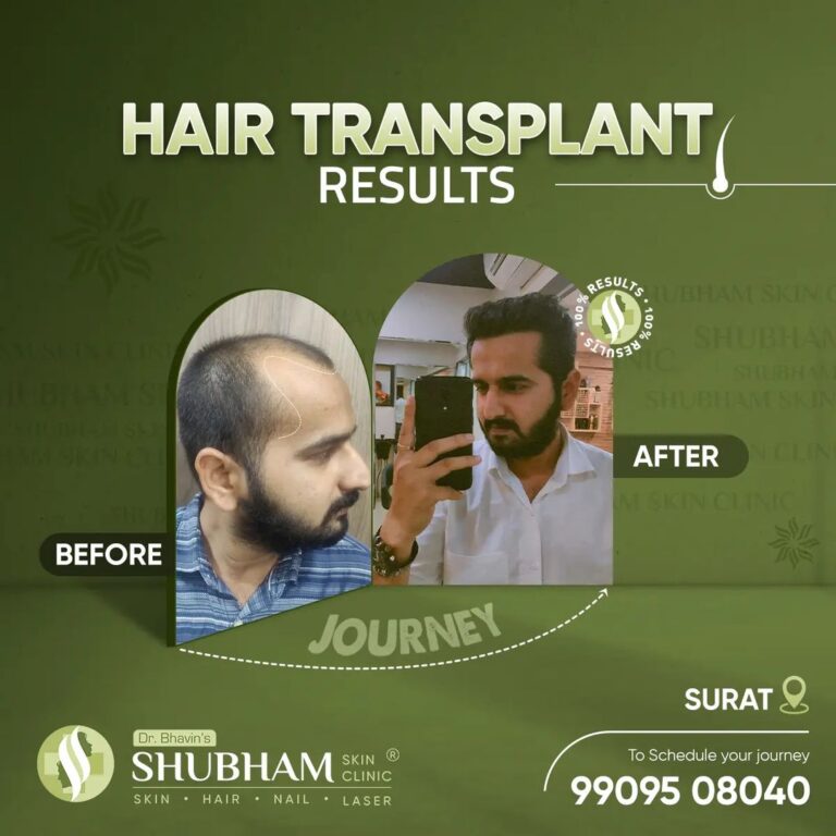 hair-transplant-treatment-man-PRP-Therapy-Hair-Loss-Treatment