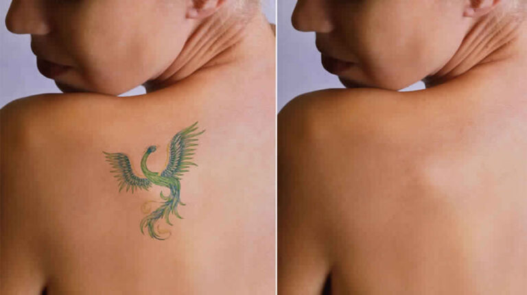 back-shoulder-tattoo-Removel-after-and-before