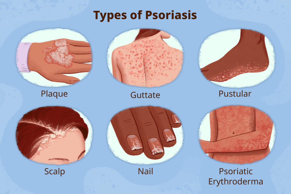Symptom-Of-Psoriasis​​