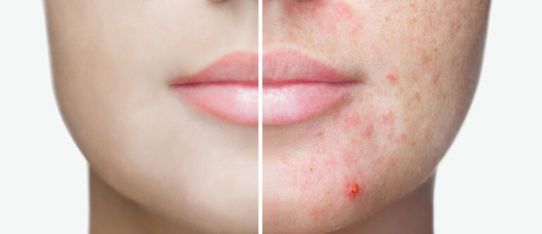 Laser-For-Acne-&-Lesions​Acne-Scar-Before-and-After