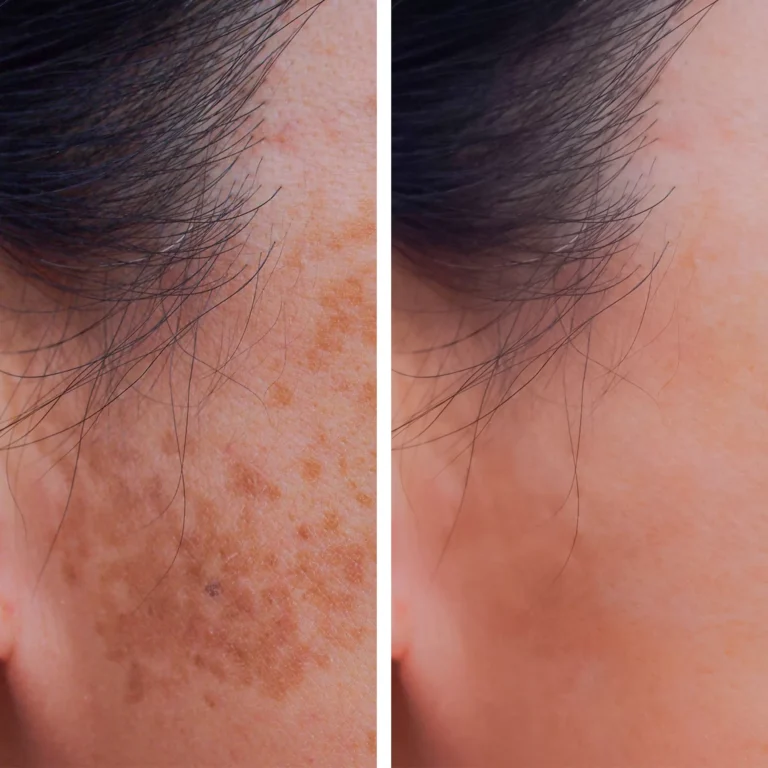 Laser-For-Pigmented-Lesions-before-and-after