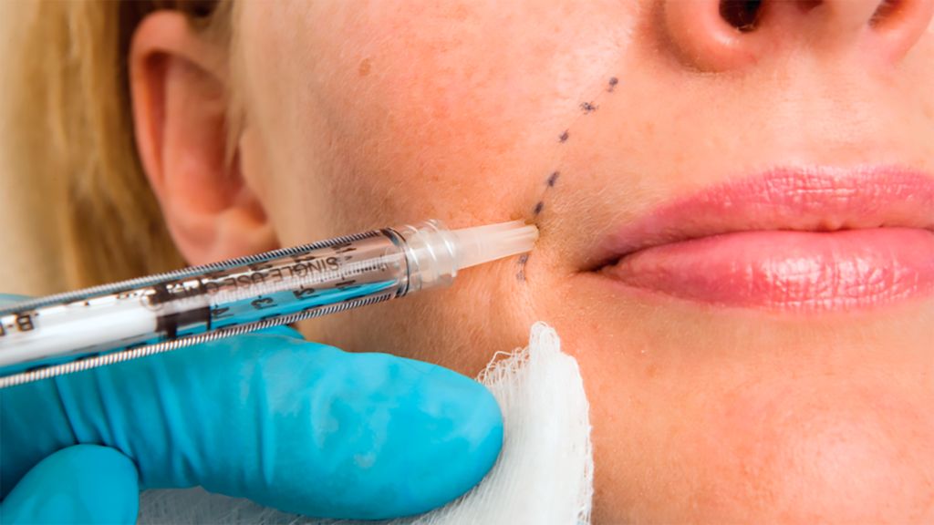 dermal-fillers