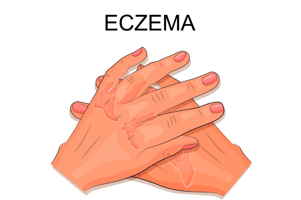 Eczema-skin-treatment