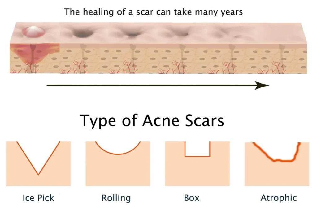 type-of-Acne-Scar