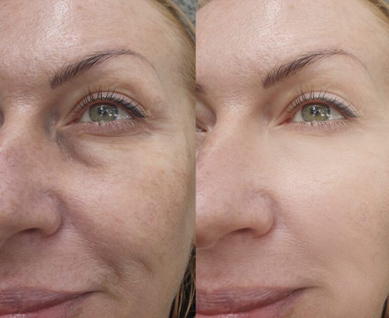 Laser-Bleach-&-Laser-Facial​-Before-and-after