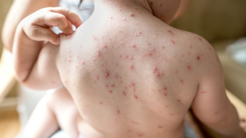 Skin-Viral-Infection-treatment