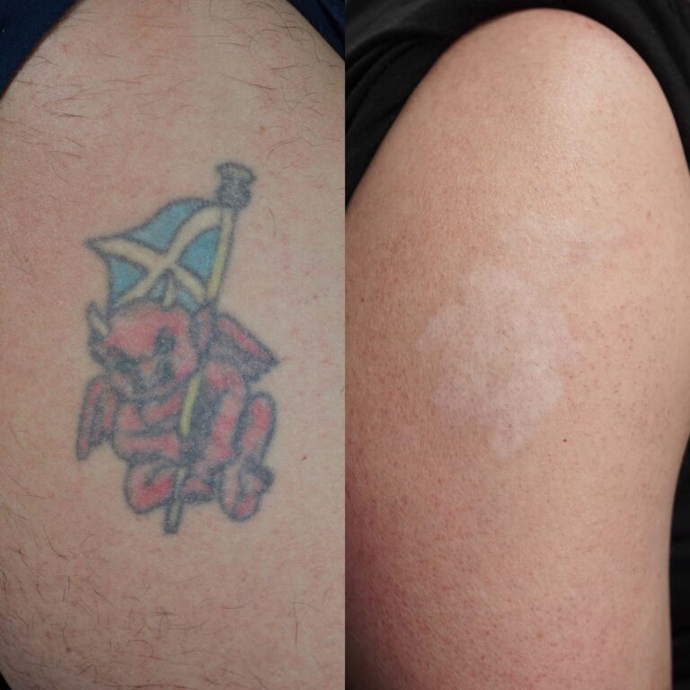 Arm-tattoo-Removel-after-and-before