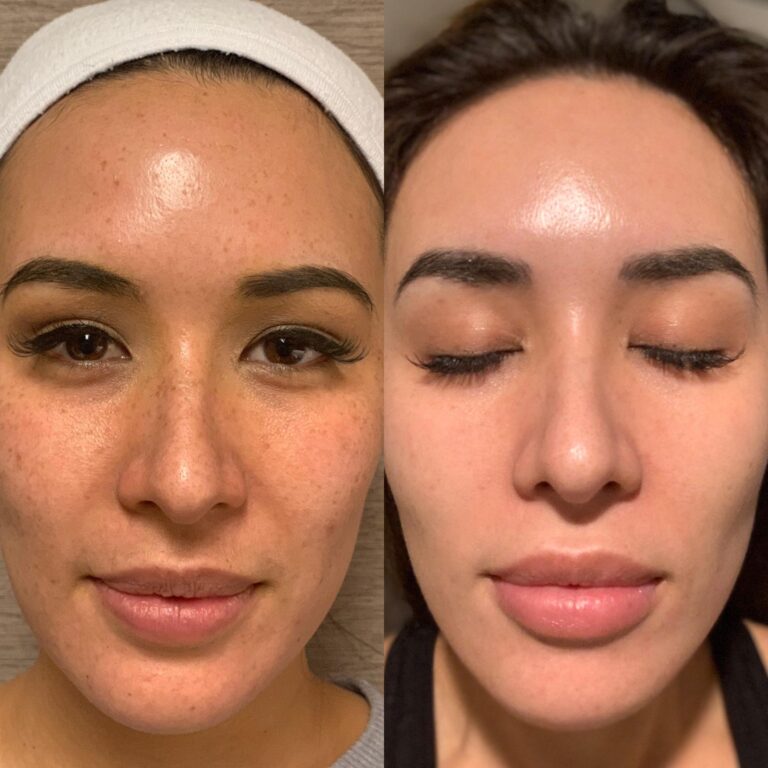 Laser-Bleach-&-Laser-Facial​-Before-and-after