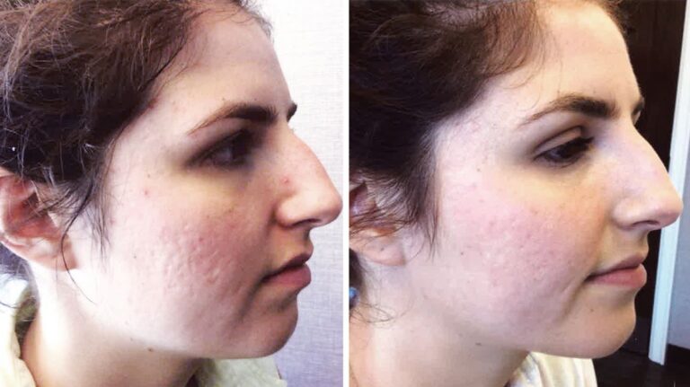 Laser-For-Acne-&-Lesions​Acne-Scar-Before-and-After