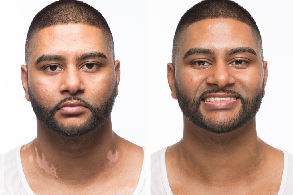 Vitiligo-treatment-before-after