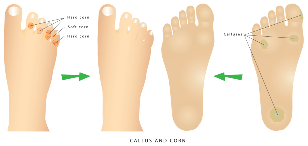 Corn-Removal