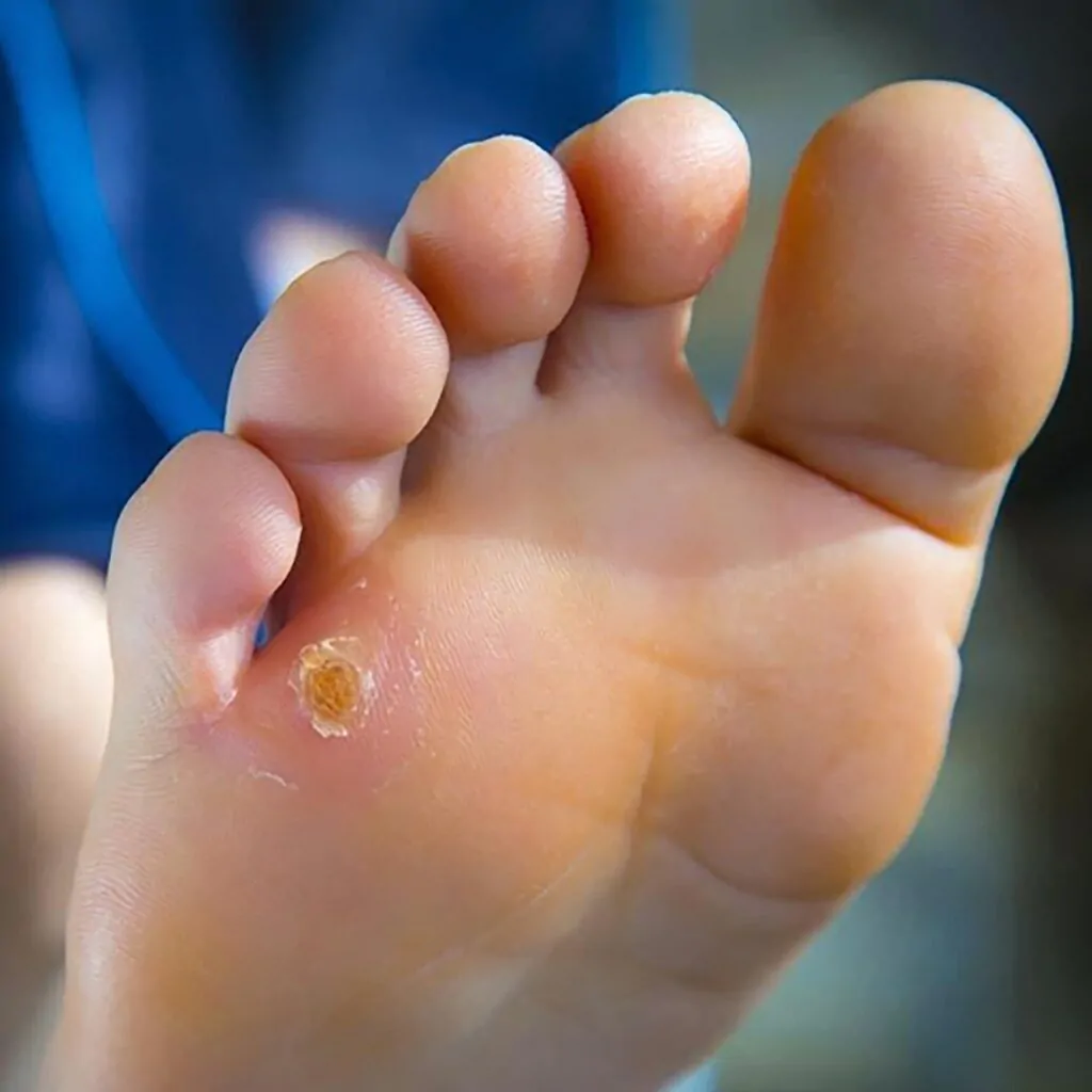 Corn-Callus-Corn-Removal-treatment