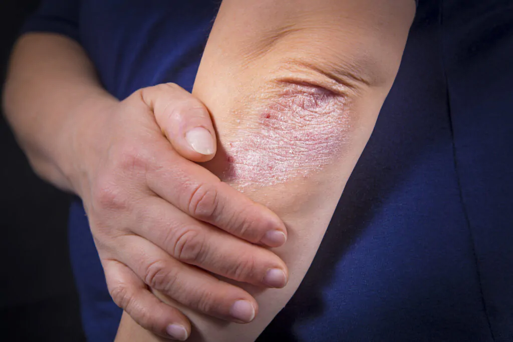 Psoriasis-skin-treatment