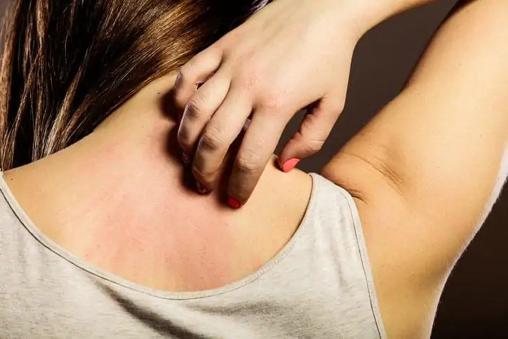 Skin-Center-of-Rashes-from-Skin-Allergies