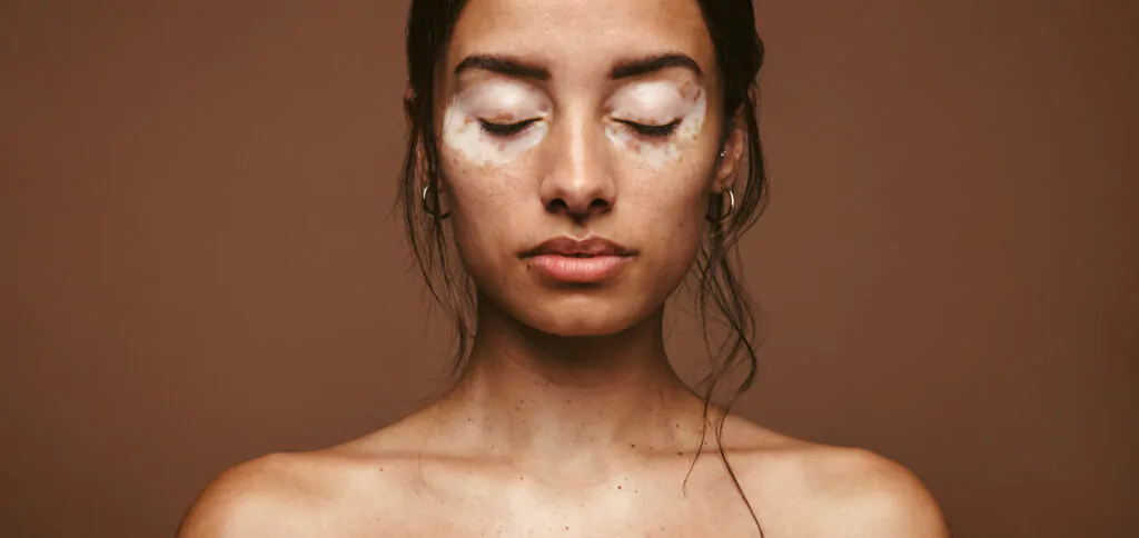 Vitiligo-skin-treatment