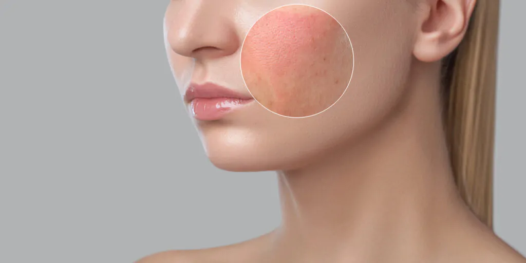 A-young-girl-with-a-skin-Allergy-problem-Photo-before-and-after-treatment-for-Skin-treatment,-Cosmetology-and-professional-skin care.