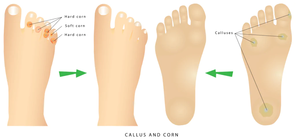 Corn-Removal